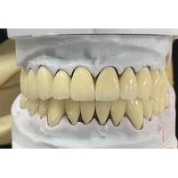 Implant Crown and Bridge