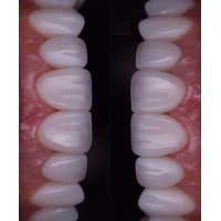 Layered Zirconia Crown - China Dental Lab Dental Crown in Good Quality, Good Fitting and Good Esthetics