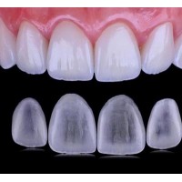 Zirconia Crowns - China Dental Lab Dental Crowns in Good Quality and Good Esthetics