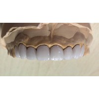 Pfm Crowns - China Dental Lab Dental Crowns Metal Porcelain Crowns in
