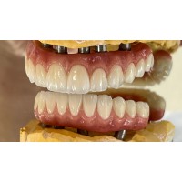 Pfm Bridge -- China Dental Lab Dental Crown in Good Quality and Good Esthetics
