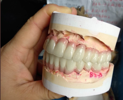 Crown Bridge Zirconia China Dental Lab
