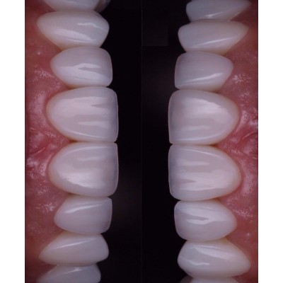 Layered Zirconia Crown - China Dental Lab Dental Crown in Good Quality, Good Fitting and Good Esthetics