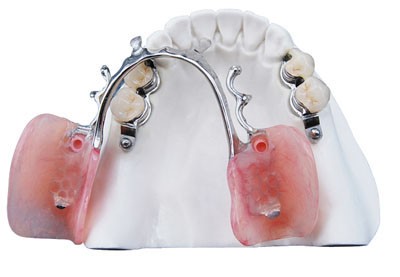 Pfm Bridge -- China Dental Lab Dental Crown in Good Quality and Good Esthetics