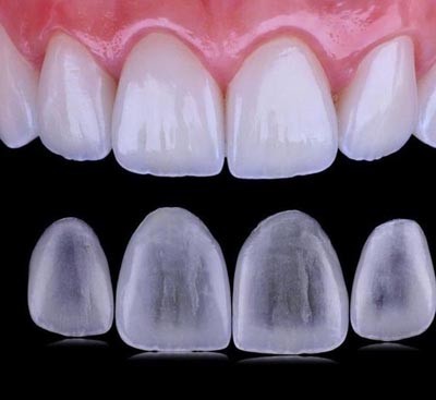 Zirconia Crowns - China Dental Lab Dental Crowns in Good Quality and Good Esthetics