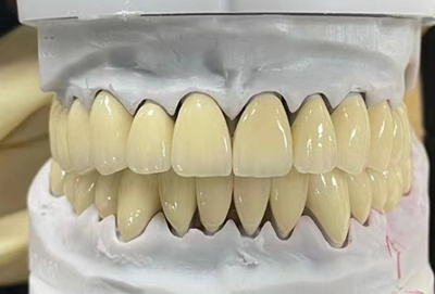 Pfm Bridge -- China Dental Lab Dental Crown in Good Quality and Good Esthetics